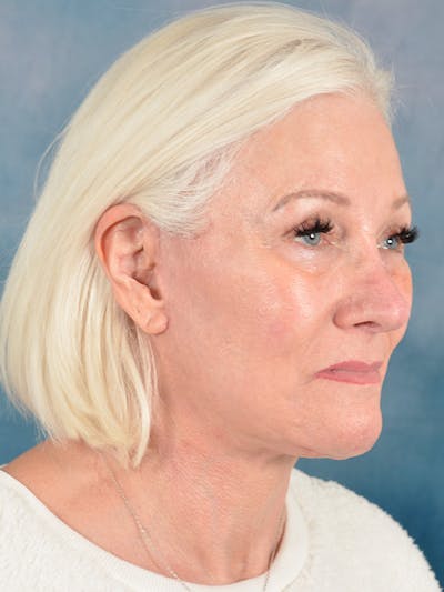 Brow Lift Before & After Gallery - Patient 178213 - Image 6