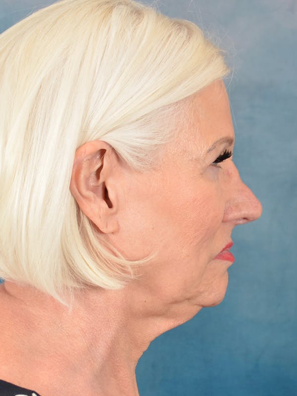 Deep Plane Facelift Before & After Gallery - Patient 271636 - Image 7
