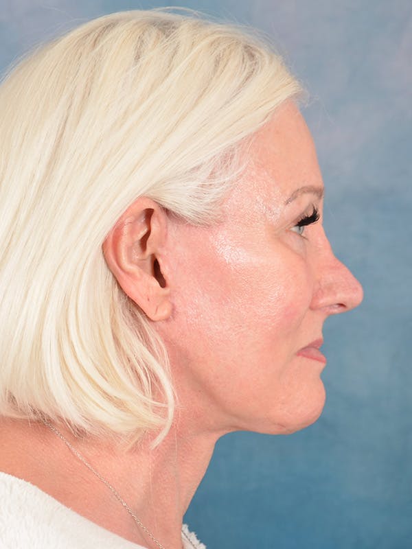 Deep Plane Facelift Before & After Gallery - Patient 271636 - Image 8