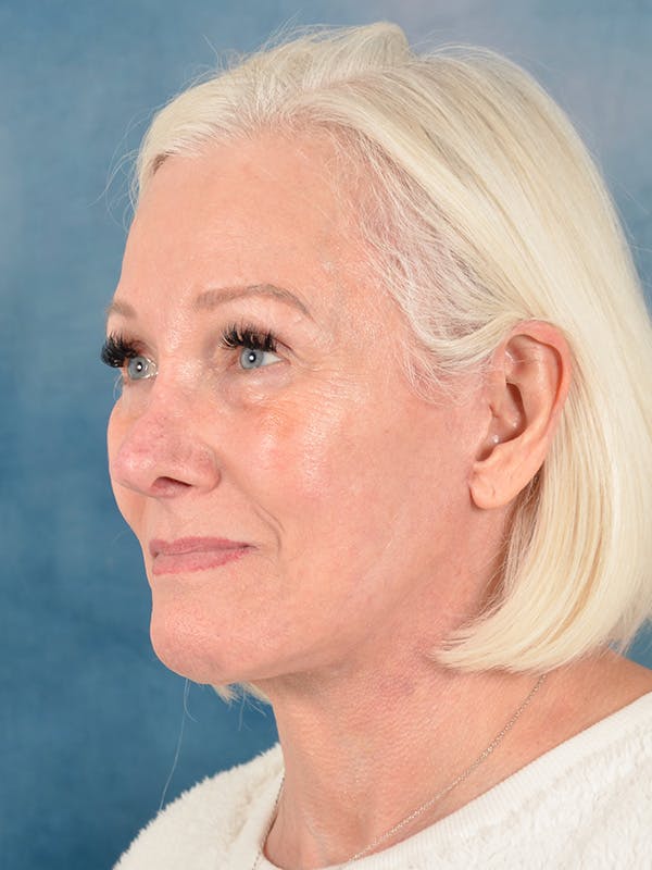 Laser Skin Resurfacing Before & After Gallery - Patient 186670 - Image 4