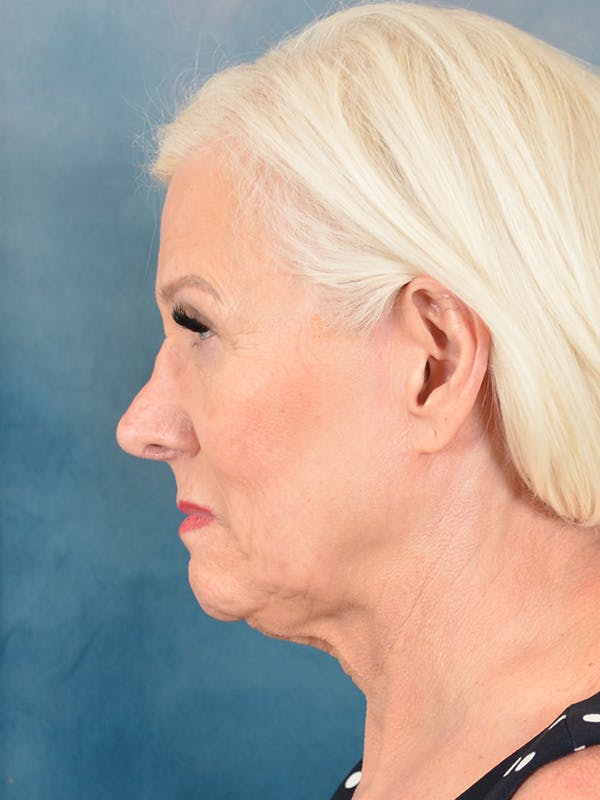 Deep Plane Facelift Before & After Gallery - Patient 271636 - Image 9