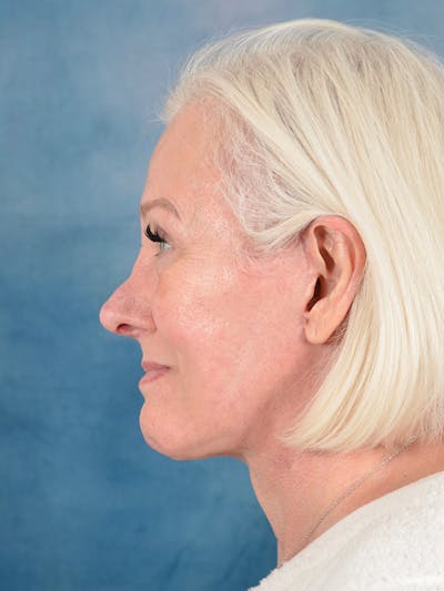 Deep Plane Facelift Before & After Gallery - Patient 271636 - Image 10