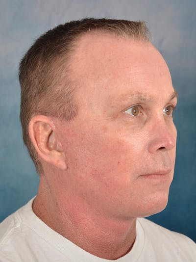 Deep Plane Facelift Before & After Gallery - Patient 151842 - Image 6