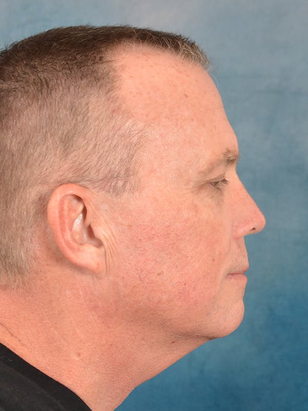 Rhinoplasty Before & After Gallery - Patient 200865 - Image 9
