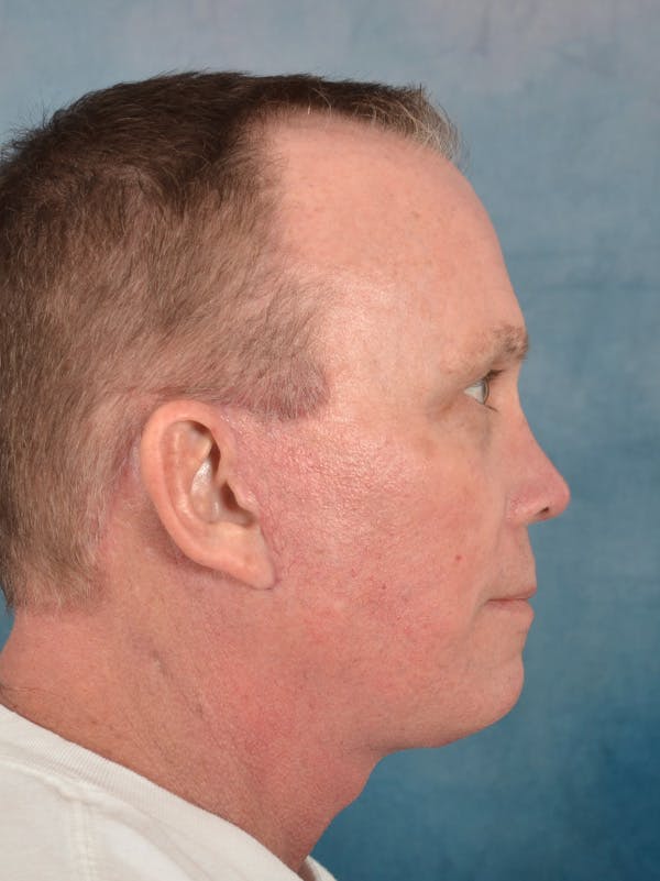 Rhinoplasty Before & After Gallery - Patient 200865 - Image 10