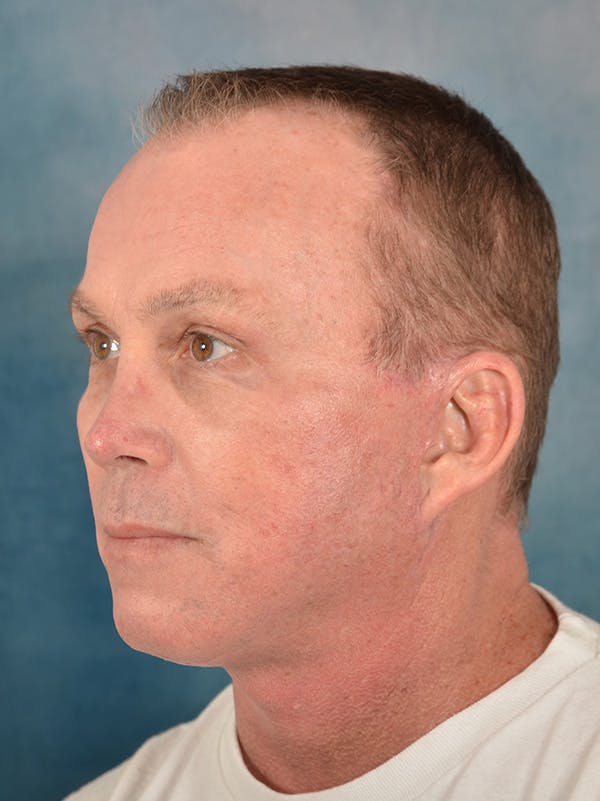Rhinoplasty Before & After Gallery - Patient 200865 - Image 4