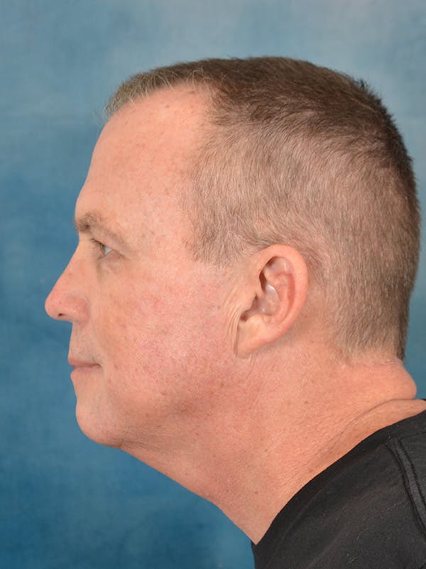Deep Plane Facelift Before & After Gallery - Patient 151842 - Image 9
