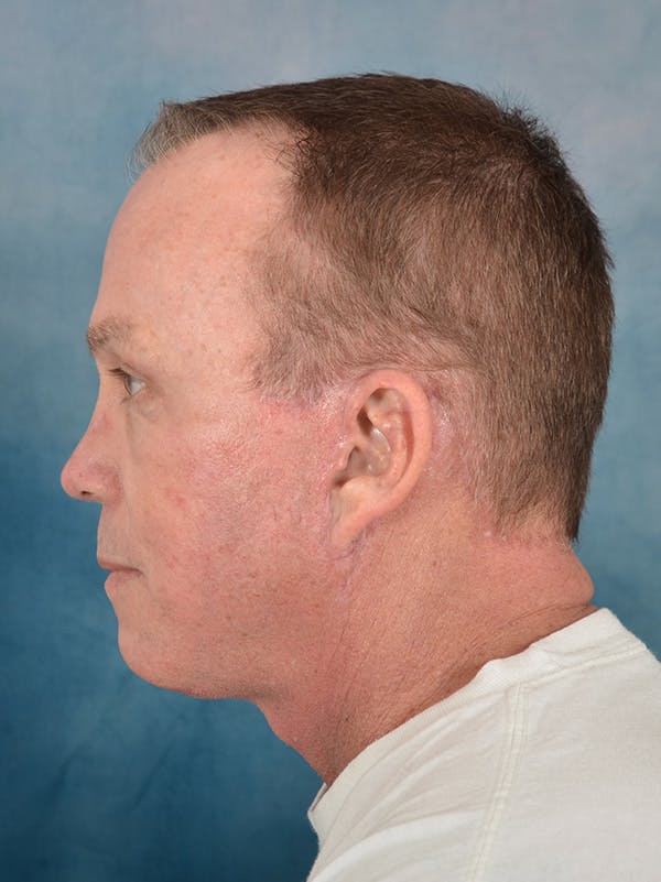 Rhinoplasty Before & After Gallery - Patient 200865 - Image 2
