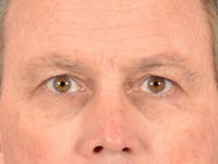 Eyelid Lift Before & After Gallery - Patient 235844 - Image 1