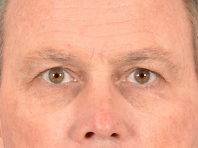 Brow Lift Before & After Gallery - Patient 737477 - Image 1