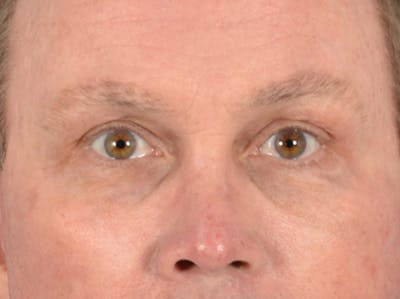 Brow Lift Before & After Gallery - Patient 737477 - Image 2