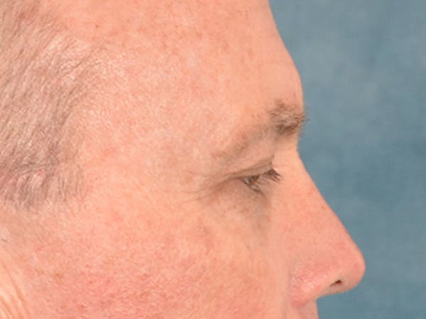 Brow Lift Before & After Gallery - Patient 737477 - Image 5