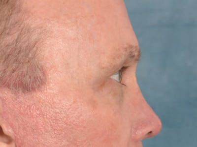 Brow Lift Before & After Gallery - Patient 737477 - Image 6