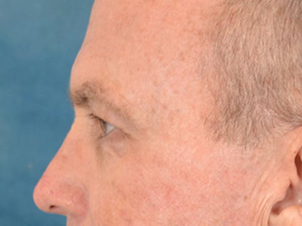 Brow Lift Before & After Gallery - Patient 737477 - Image 9