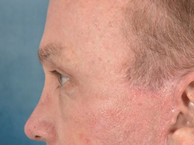 Brow Lift Before & After Gallery - Patient 737477 - Image 10