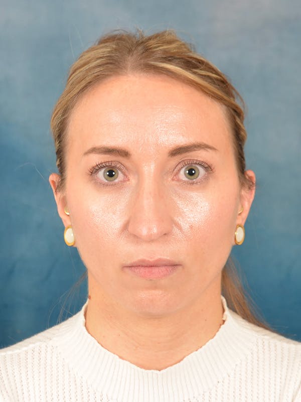 Rhinoplasty Before & After Gallery - Patient 243923 - Image 5