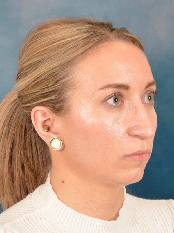 Rhinoplasty Before & After Gallery - Patient 243923 - Image 7