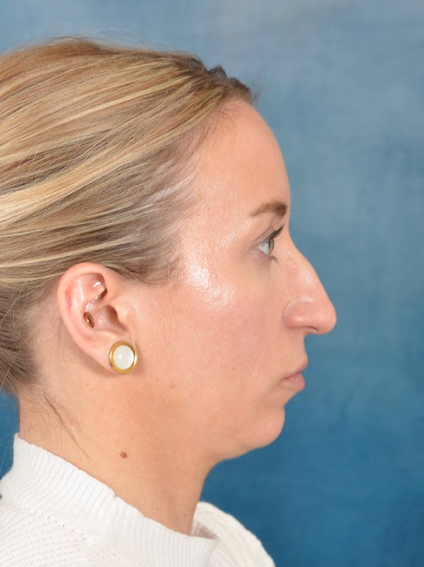 Rhinoplasty Before & After Gallery - Patient 243923 - Image 9