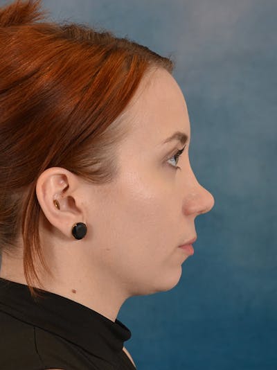 Rhinoplasty Before & After Gallery - Patient 243923 - Image 10