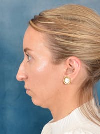 Rhinoplasty Before & After Gallery - Patient 243923 - Image 1