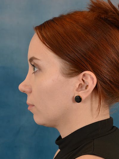 Rhinoplasty Before & After Gallery - Patient 243923 - Image 2