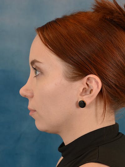 Rhinoplasty Before & After Gallery - Patient 243923 - Image 2