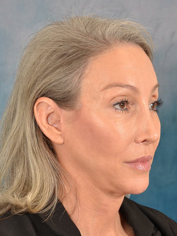 Deep Plane Facelift Before & After Gallery - Patient 502468 - Image 6