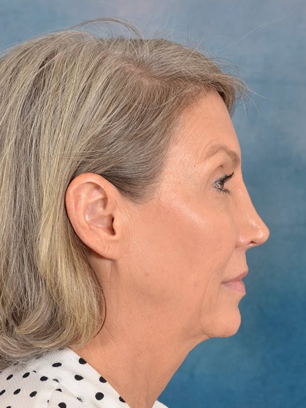 Brow Lift Before & After Gallery - Patient 117647 - Image 7