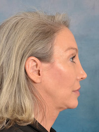 Brow Lift Before & After Gallery - Patient 117647 - Image 8