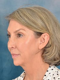 Deep Plane Facelift Before & After Gallery - Patient 502468 - Image 1