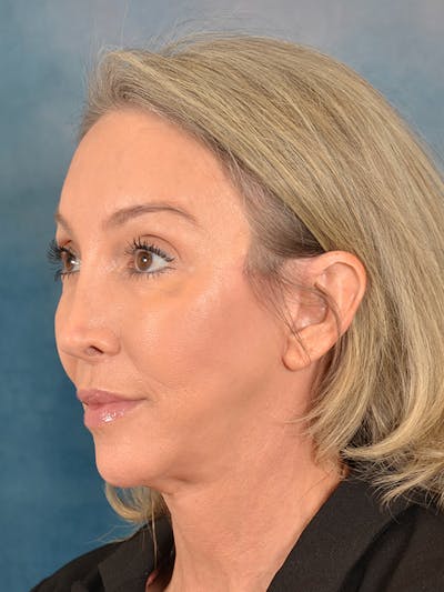 Deep Plane Facelift Before & After Gallery - Patient 502468 - Image 2