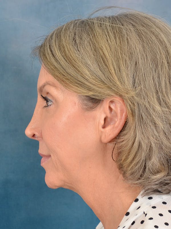 Deep Plane Facelift Before & After Gallery - Patient 502468 - Image 9