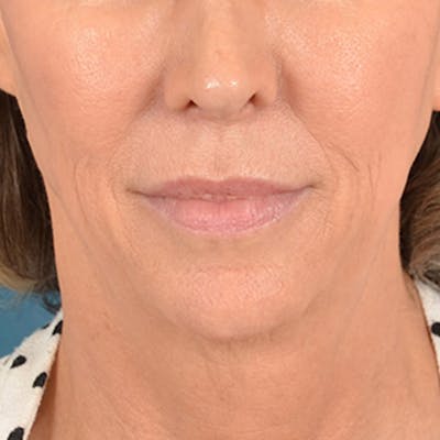 Lip Lift Before & After Gallery - Patient 194471 - Image 1