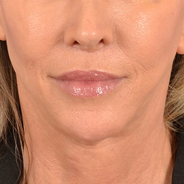 Lip Lift Before & After Gallery - Patient 194471 - Image 2