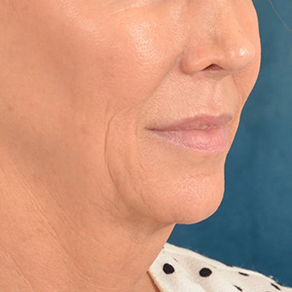 Lip Lift Before & After Gallery - Patient 194471 - Image 3