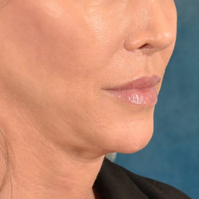 Lip Lift Before & After Gallery - Patient 194471 - Image 4