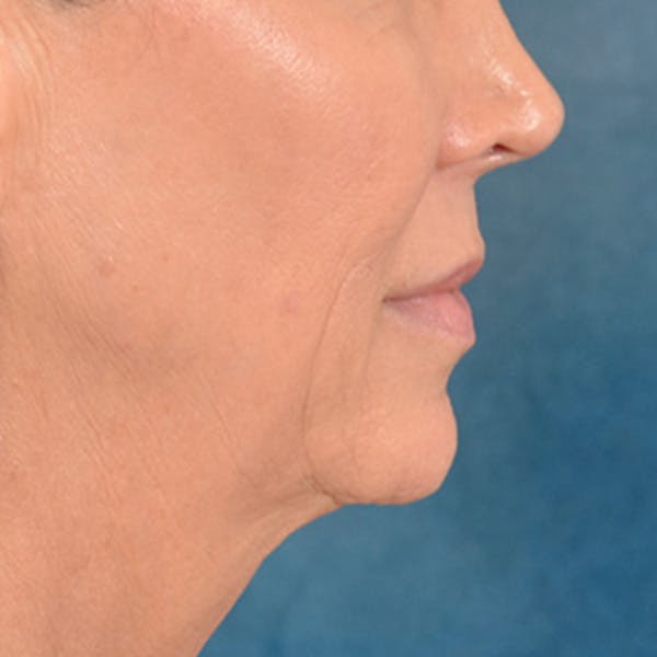 Lip Lift Before & After Gallery - Patient 194471 - Image 5