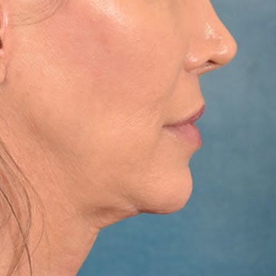 Lip Lift Before & After Gallery - Patient 194471 - Image 6