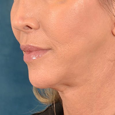 Lip Lift Before & After Gallery - Patient 194471 - Image 8