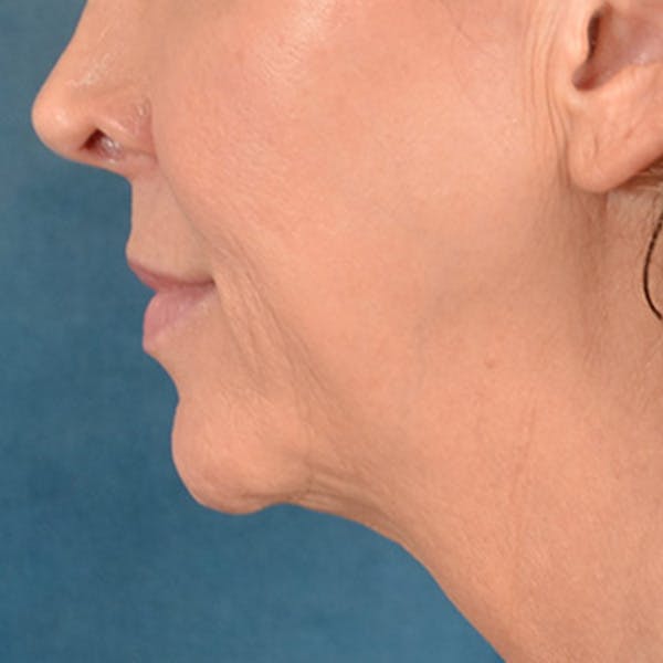 Lip Lift Before & After Gallery - Patient 194471 - Image 9