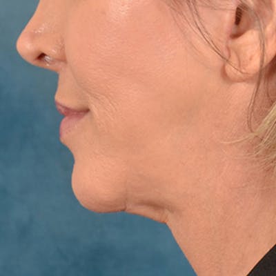 Lip Lift Before & After Gallery - Patient 194471 - Image 10