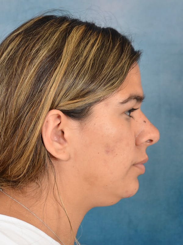 Deep Neck Lift Before & After Gallery - Patient 344742 - Image 5
