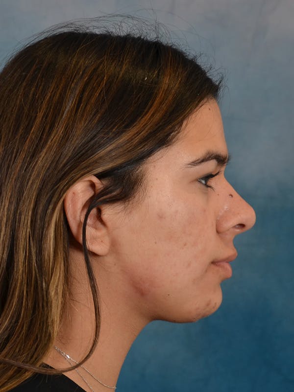 Deep Neck Lift Before & After Gallery - Patient 344742 - Image 6