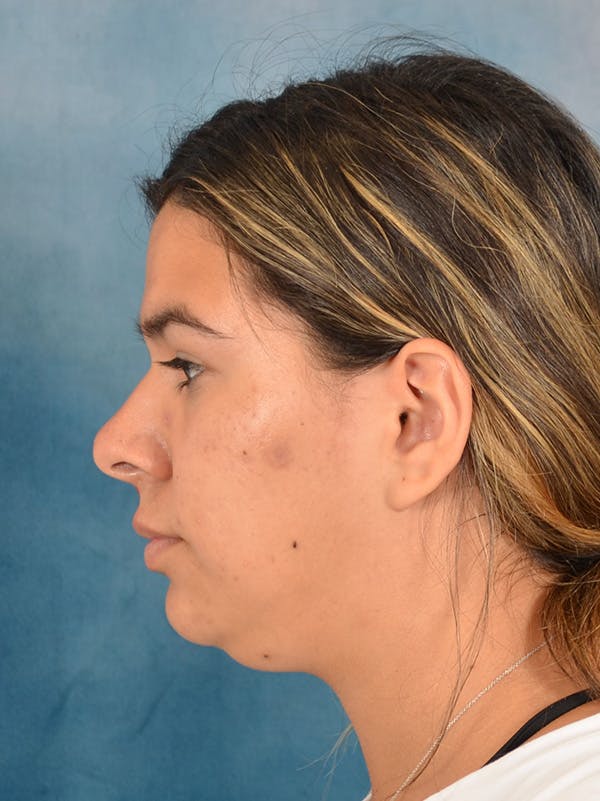 Deep Neck Lift Before & After Gallery - Patient 344742 - Image 9