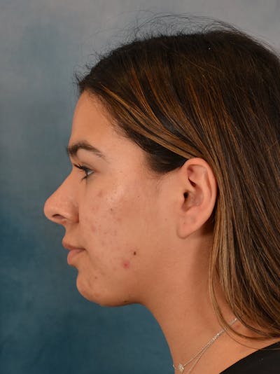 Morpheus8 Before & After Gallery - Patient 418994 - Image 10