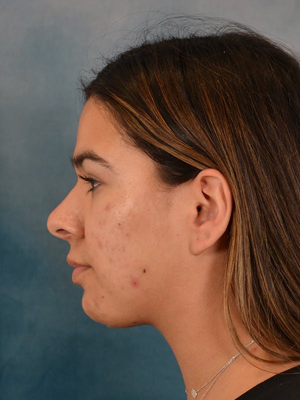 Deep Neck Lift Before & After Gallery - Patient 344742 - Image 10