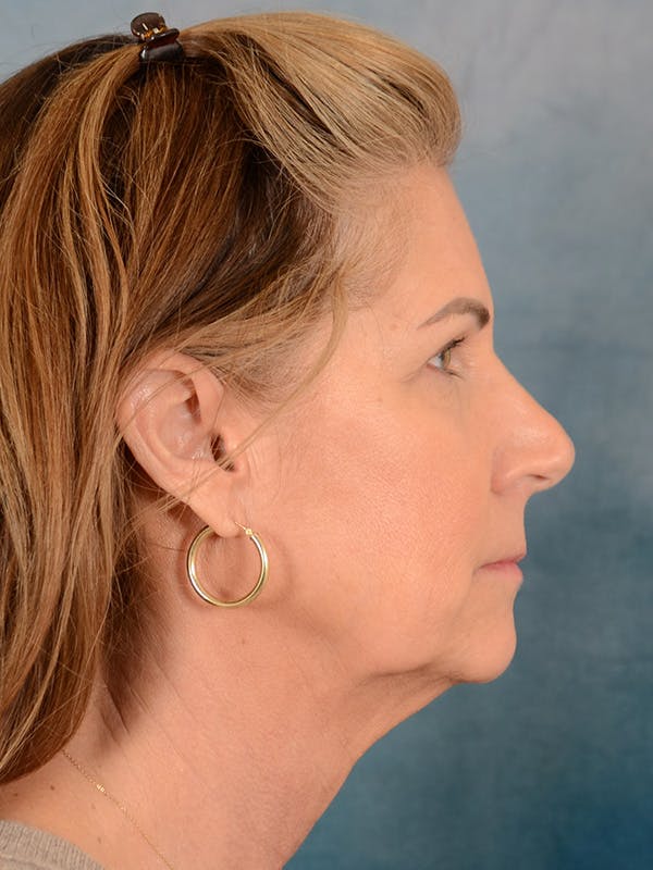 Deep Plane Facelift Before & After Gallery - Patient 334225 - Image 9