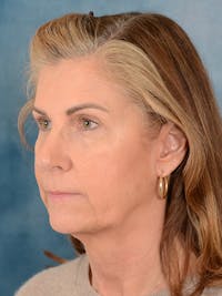 Deep Plane Facelift Before & After Gallery - Patient 334225 - Image 1