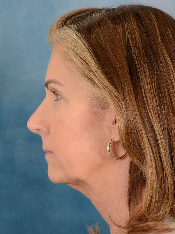 Brow Lift Before & After Gallery - Patient 393290 - Image 5