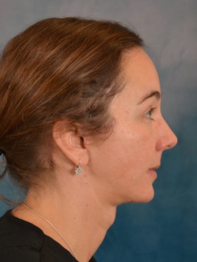 Deep Plane Facelift Before & After Gallery - Patient 129539 - Image 10